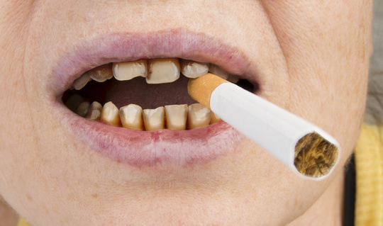 タバコを吸っていたら歯周病 歯槽膿漏 になりやすい 歯科コラム 公式 フォレストデンタルクリニック鴻巣院 鴻巣市 鴻巣駅