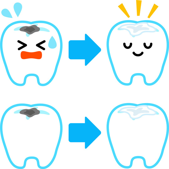 歯科 上顎ジルコニアBr 歯科 歯科技工 上顎ジルコニアBr